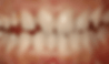 Veneers.gif