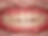INNOSMILE | Perfect Clear Aligner
