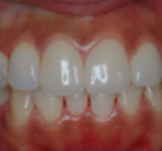 Final Veneers.jpg