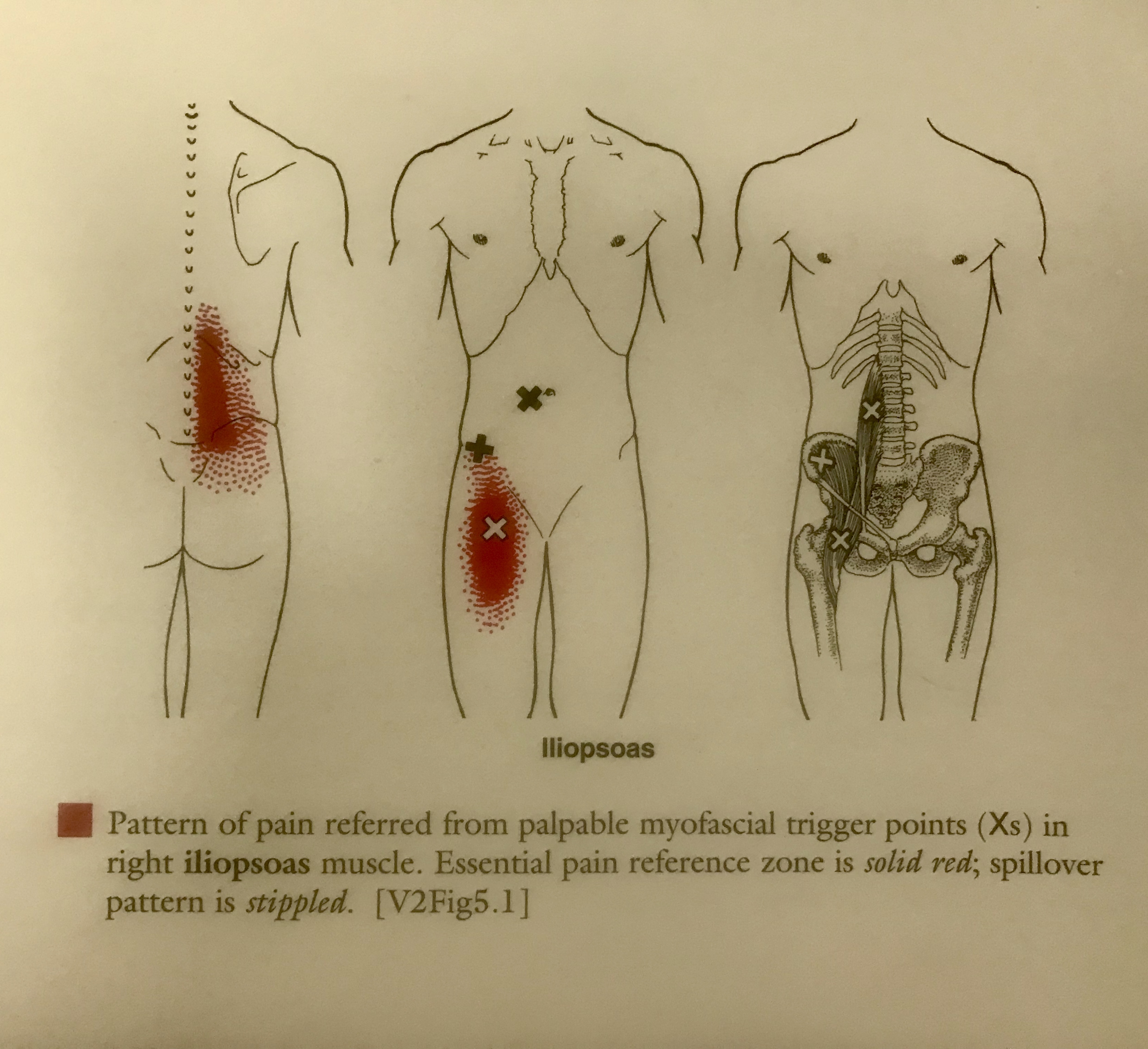 Travell and simons trigger pain point patterns chart lasopaexcel