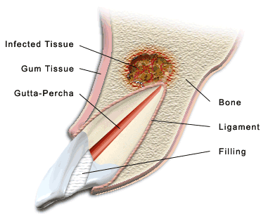 apicoectomy5.gif