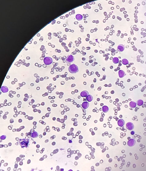 acute lymphoblastic leukemia.jpg