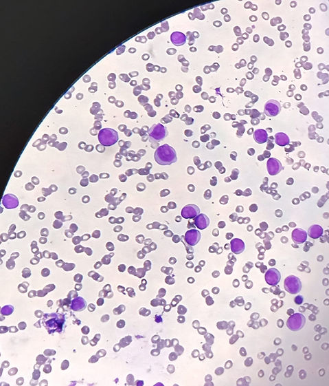 acute lymphoblastic leukemia.jpg