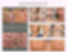 microneedling rf (3).png