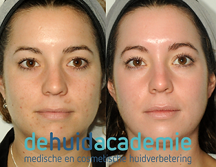 Loes Vonk product gebruik ZO Medical en ZO Skin Health producten.