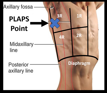 Interpostal Scanning Lung Ultrasound | Pocusstuff