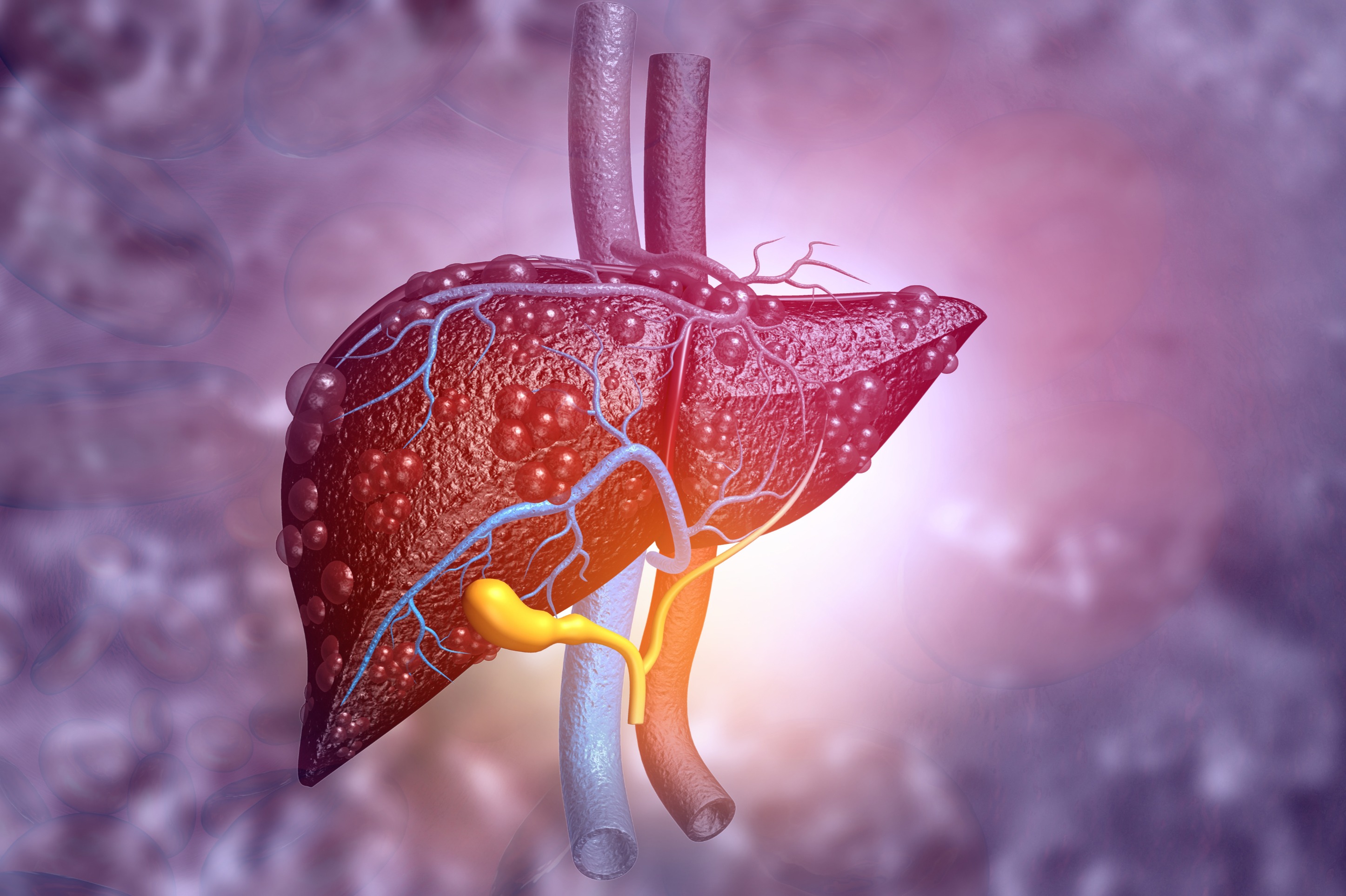 Liver Health: Preventing and Reversing Fatty Liver Disease