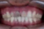 teeth darkening