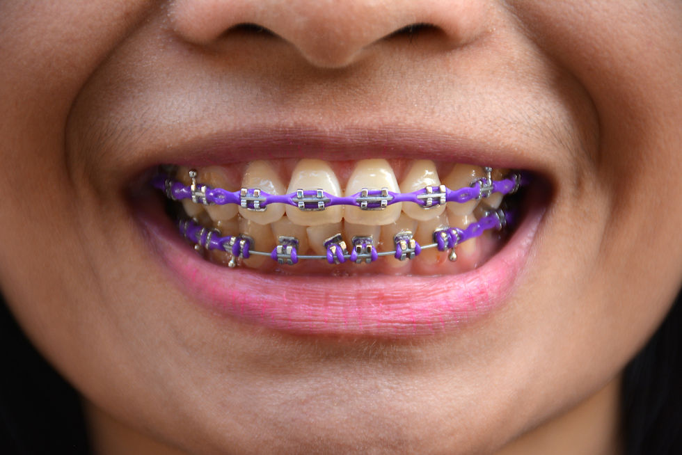 How To Choose The Perfect Braces Color For You A Complete Guide E9a807 Ca2325e4099f4defb4e150e975875235~mv2