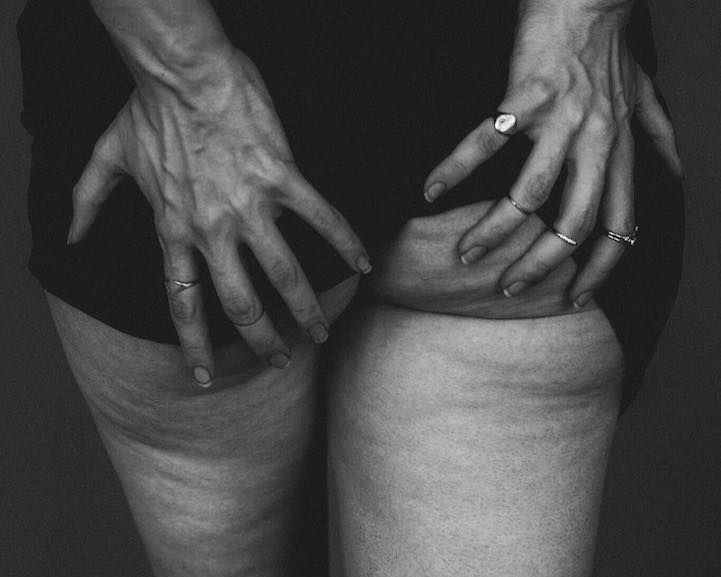 Semaglutid: Wundermittel oder Wohlstands-Shortcut?