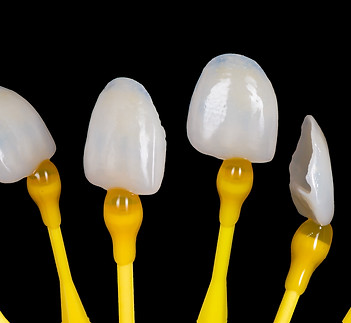 Dental Esthetic Ceramics Laminated Veneers.jpg