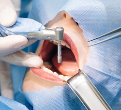 Installing-Dental-Implants-550x500