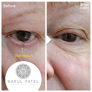 Eyelid Lesion 1.png
