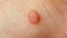 Understanding Warts: Signs, Causes, and Homeopathic Treatment