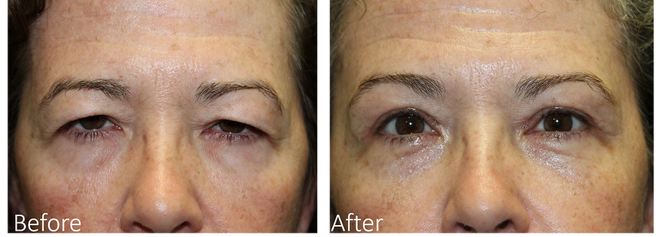 Natural Brow Lift