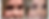 Best eyelid surgery in Dallas
