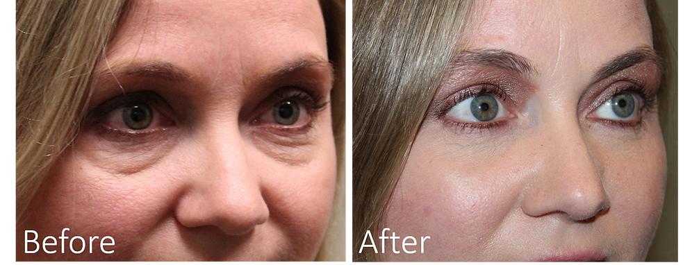 Best eyelid surgery in Dallas