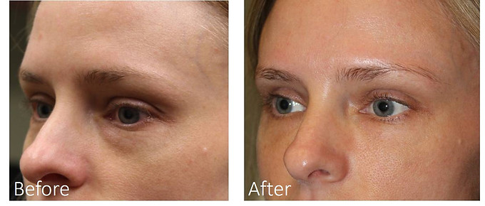 Dallas Restylane