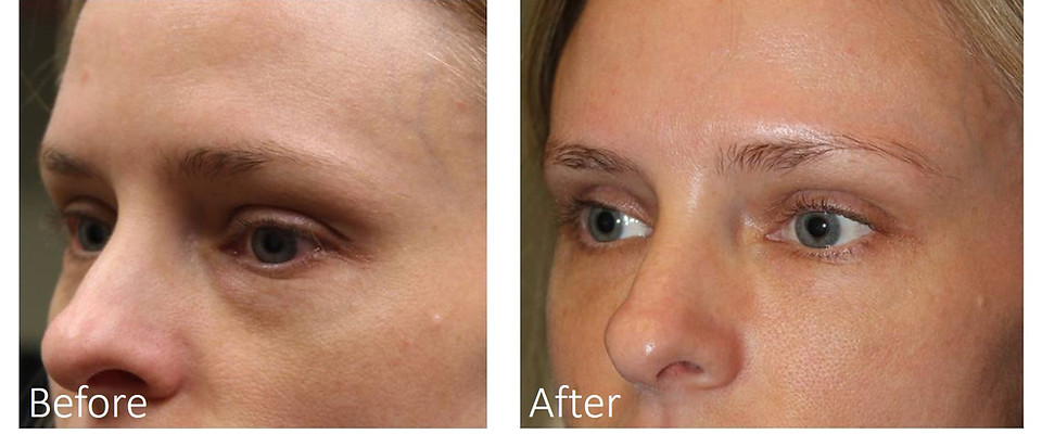 Dallas Restylane