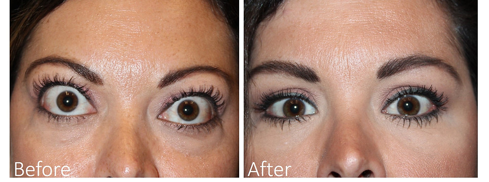 Best Thyroid Eye Surgeon