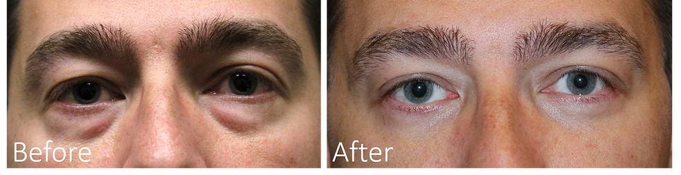 Best Male Eyelid Surgery