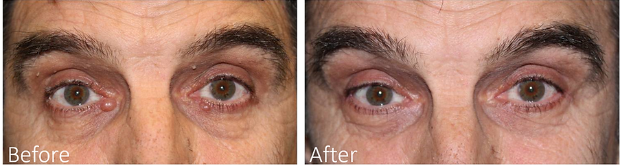 Dallas Eyelid Surgeon
