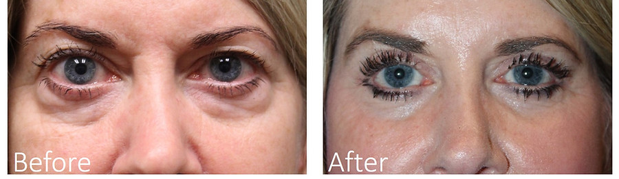 Eye Bag Sugery