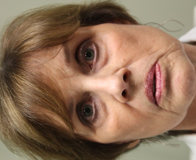 Lower eyelid bags