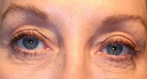 Best Blepharoplasty