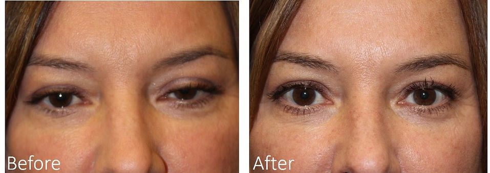 Best eyelid surgeon Dallas