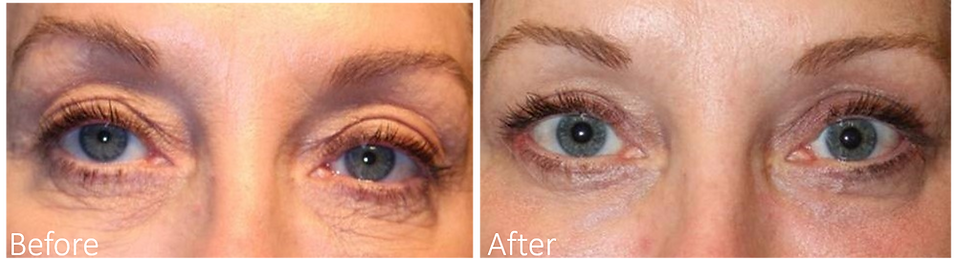 Best Blepharoplasty Surgeon Dalas