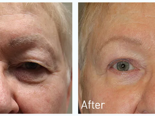 How to improve wrinkles around the eyes