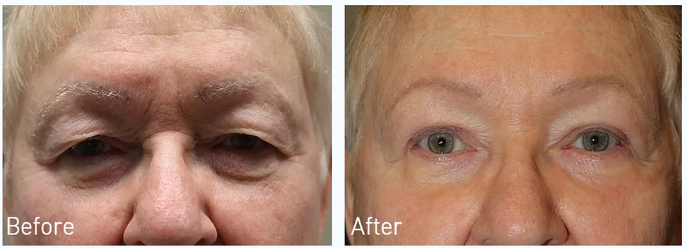 Dallas Blepharoplasty