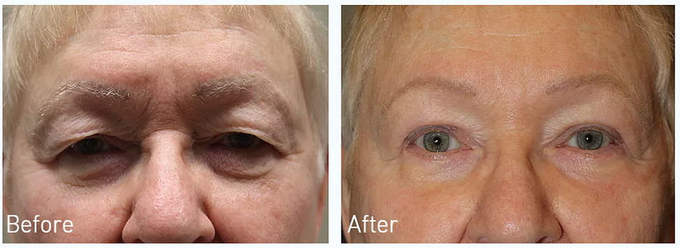 Dallas Blepharoplasty