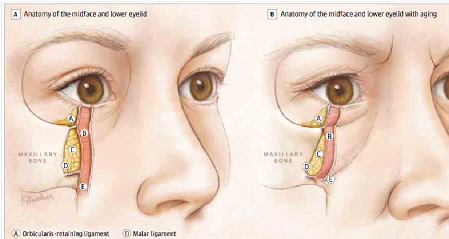 Lower eyelid bags
