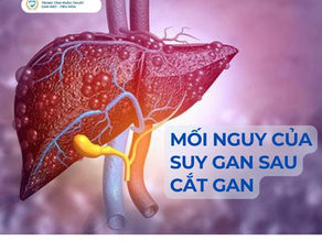 Phẫu thuật gan: Kỹ thuật ALPPS – Giải pháp cho những ca ung thư gan phức tạp