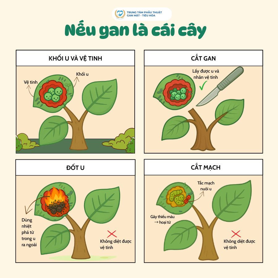 Ung thư gan: Hiểu đúng để lựa chọn phương pháp điều trị hiệu quả