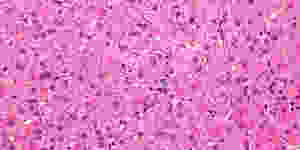 Ground_glass_hepatocytes_high_mag_2-1200x600