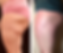Before and After Ultrasound Cavitation result
