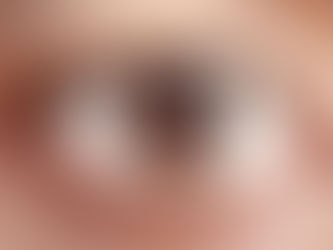 Dry, itchy eyes and menopause