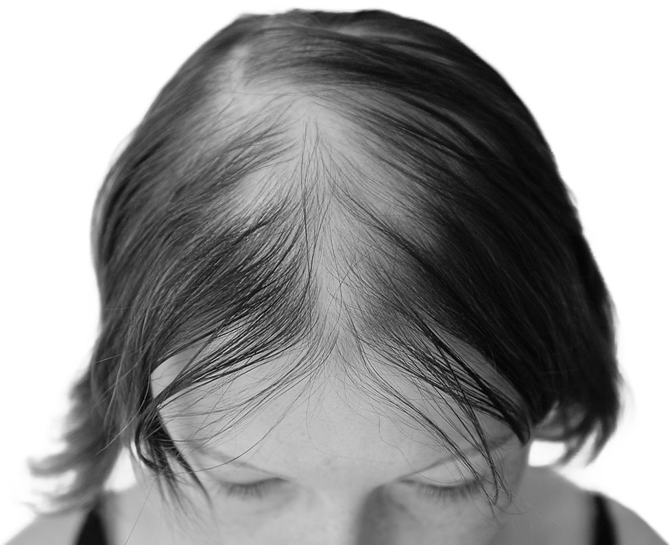 01-Folligem-Woman-HairLoss.jpg
