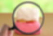 歯周病