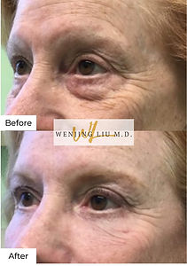 Before & after patient photo of bilateral upper eyelid blepharoplasty, bilateral lower eyelid blepharoplasty, bilateral temporal brow lift, tca peel