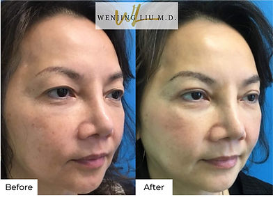 Before & after patient photo of bilateral upper eyelid blepharoplasty