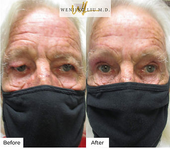 Before & after patient photo of bilateral brow lift, bilateral upper eyelid blepharoplasty