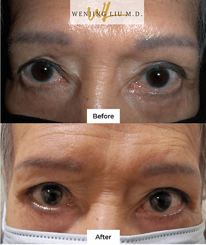 Before & after patient photo of bilateral lateral canthoplasty