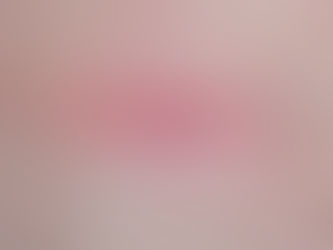 The Cellular and Molecular Mechanisms of Wound Healing and Scarring