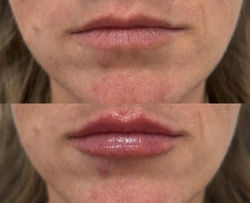 #liprefresh #subtlelip #hydratedlips