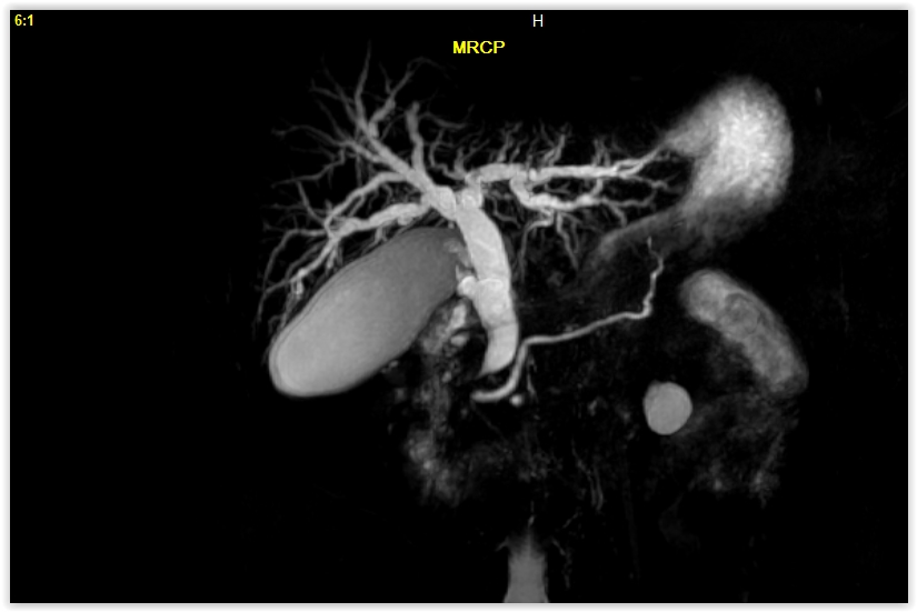 магнитно-резонансная холангиопанкреатография при жкб. анатомия желчных протоков мрт кт. магнитно-резонансная холангиопанкреатография при жкб. мрт мрхпг. мрт мрхпг.
