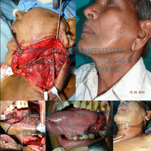 Cancer of Tongue Lateral Border